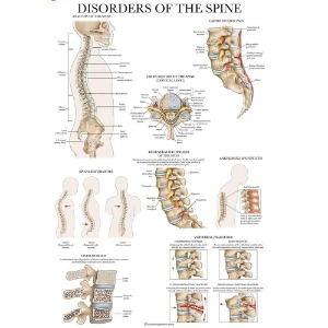 척추 질환 질병 차트 DM-11 인체해부도